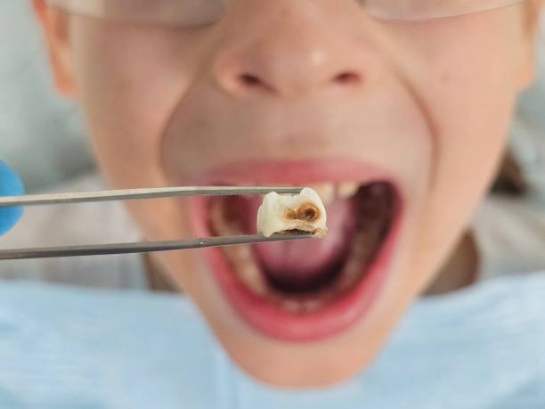 Best Emergency Treatment for Dental Infections or Abscesses in Alb, IA